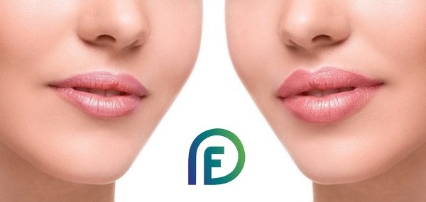 Filler lip augmentation techniques