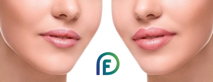 Filler lip augmentation techniques